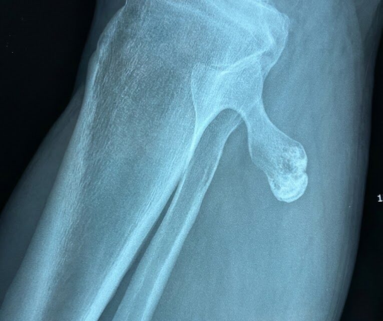 Εξόστωση στα παιδιά!Πρέπει να ανησυχώ;